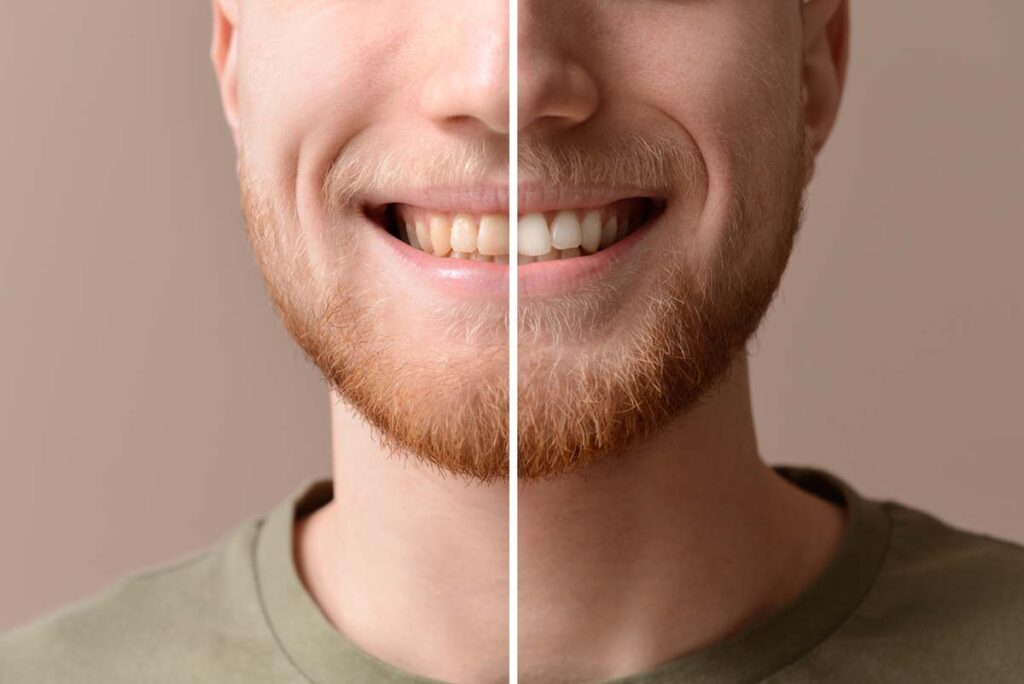 Man before and after whitening of his teeth on color background