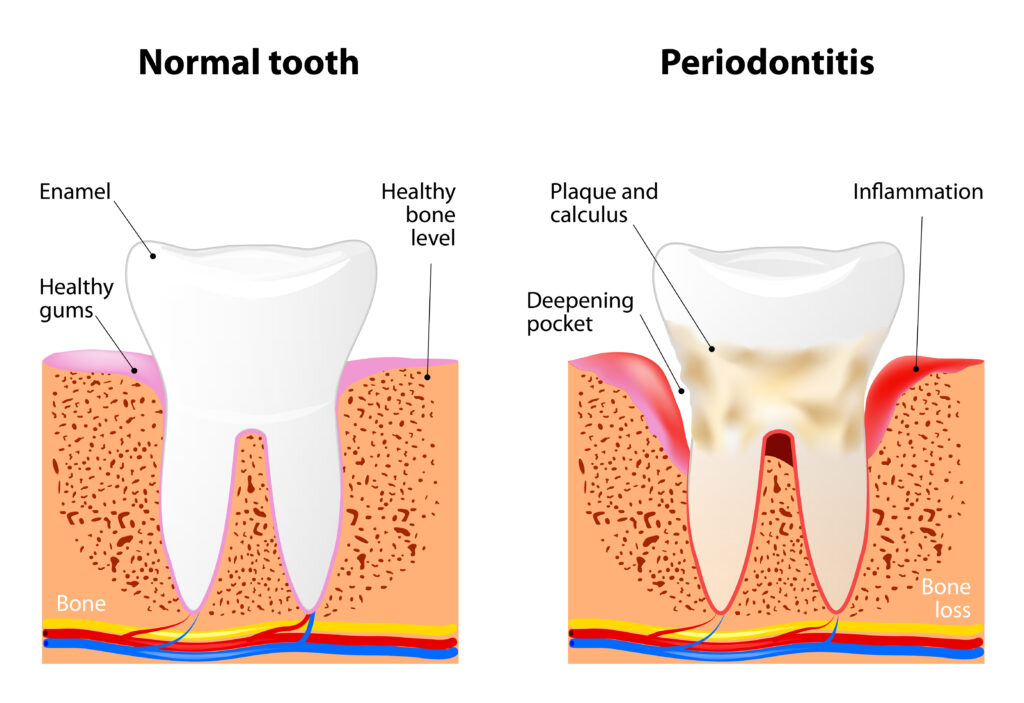 A diagram showing what a normal tooth looks like and what a tooth with periodontitis looks like. The periodontitis model shows gum inflammation, deepening pockets, and plaque/calculus